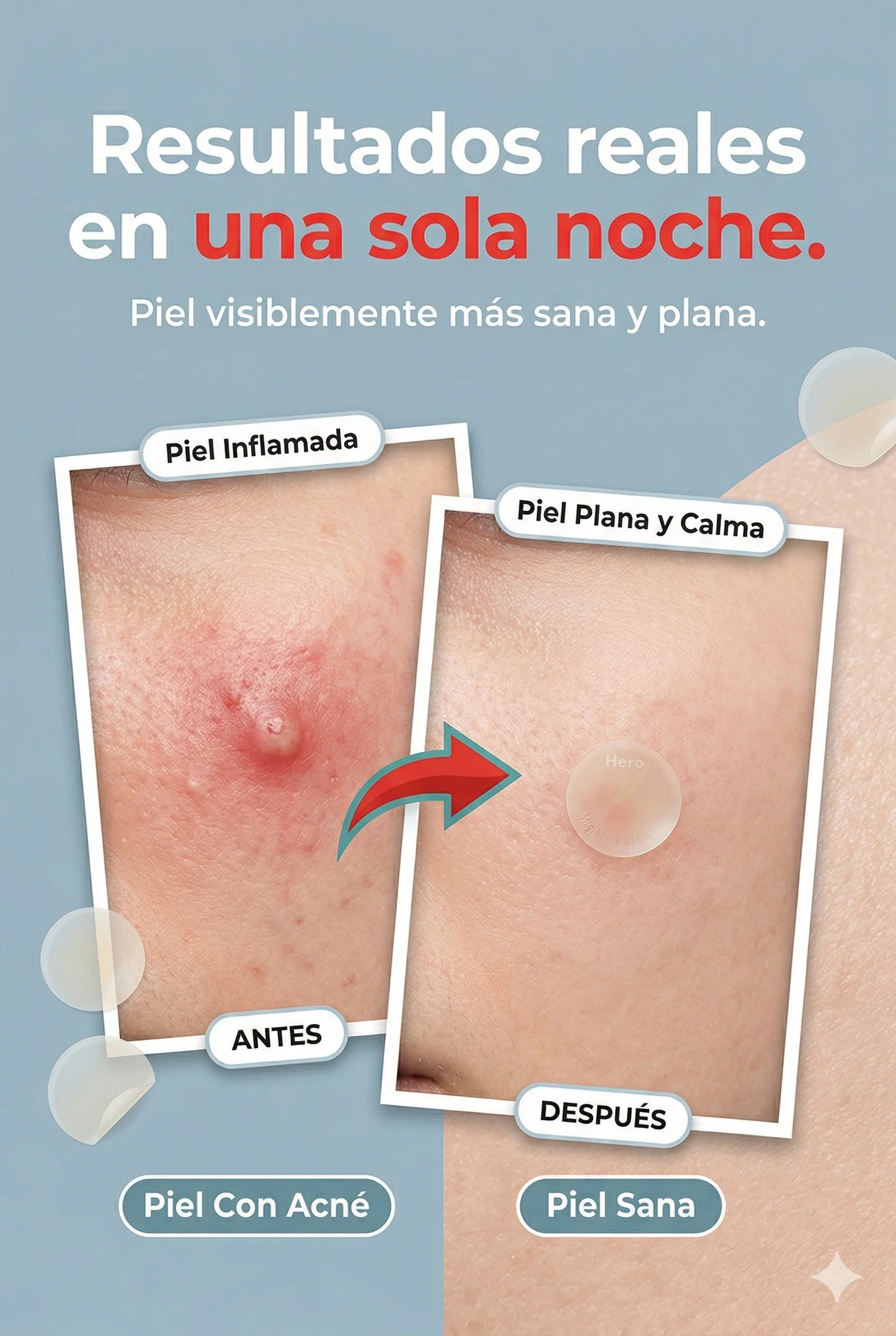 Mighty Patch™: Adiós Acné y Granos Visibles con Tecnología Hidrocoloide.